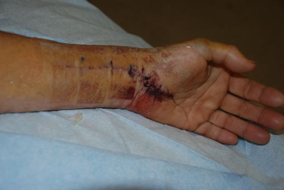 This is what it looks like under the cast.