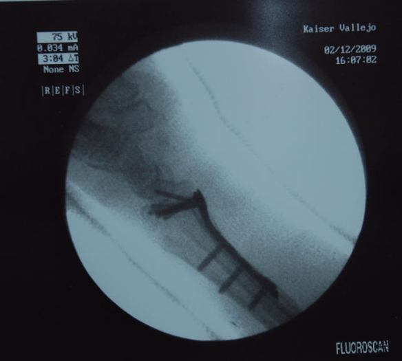 Here's what it looks like under the skin!