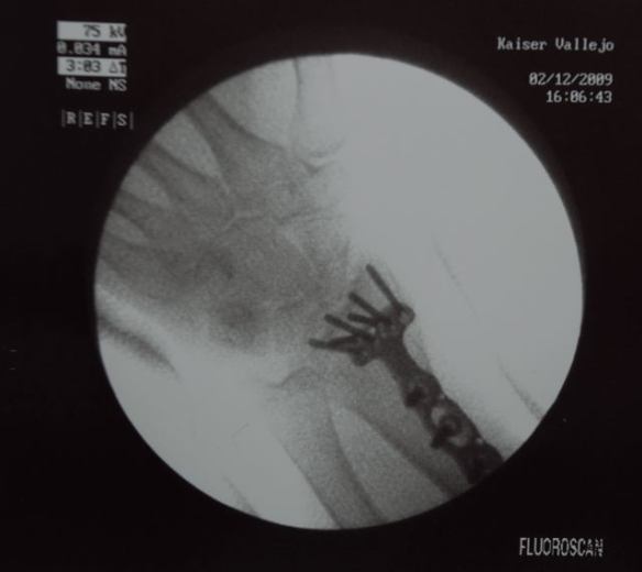 I think I counted 6 screws at the top.