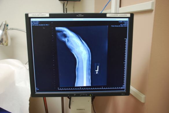 This is yje new x-ray that shows the wrist bines kind of settling into where the radius is supposed to be healing--at least I think that is what it shows..